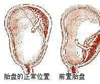 瘢痕子宫是什么意思-(孕晚期瘢痕子宫是什么意思)