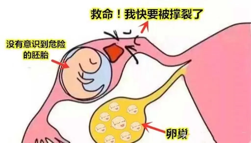 怎么样会宫外孕(宫外怀孕怎么处理最好的方法)