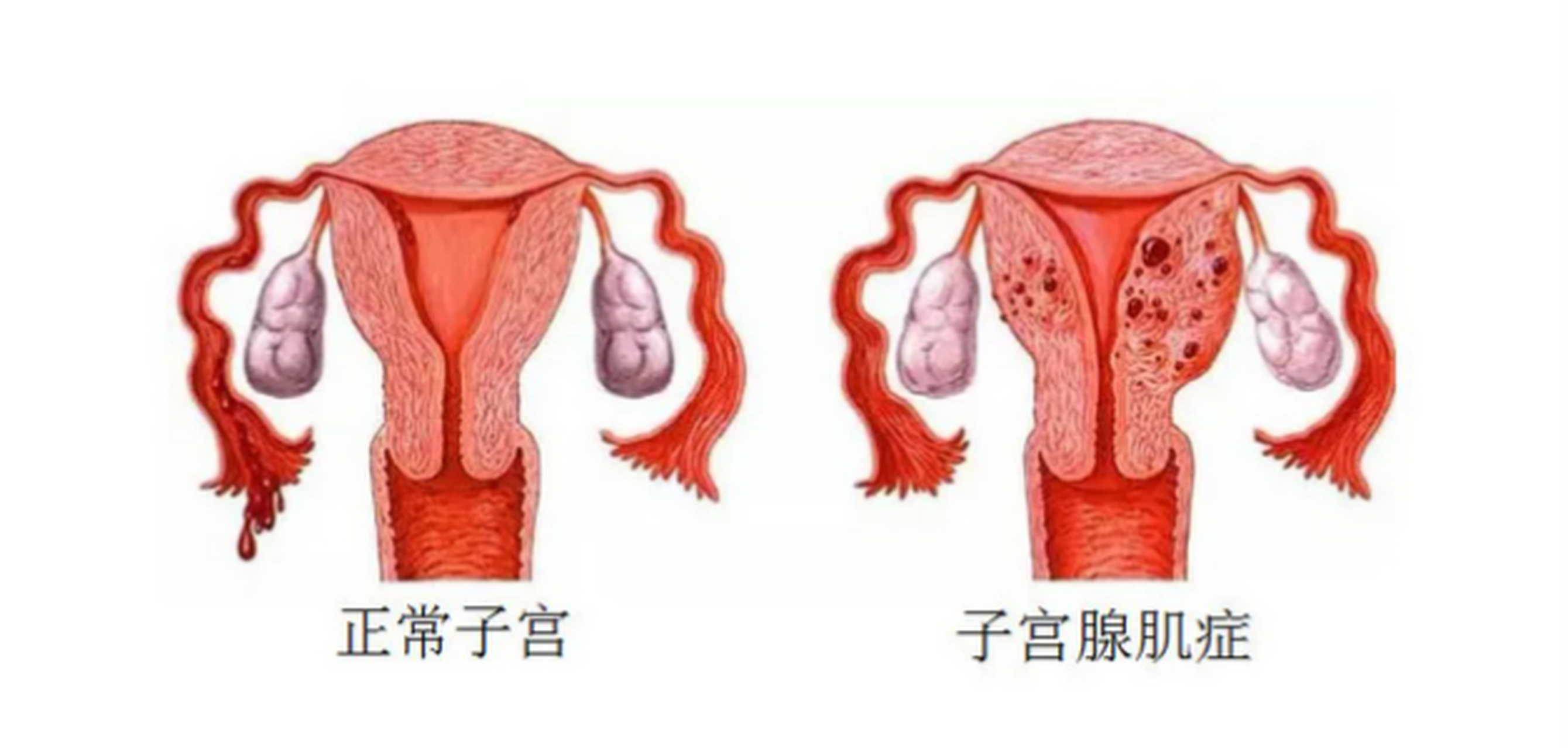 子宫腺肌症能怀孕吗(子宫腺肌症能怀孕吗北京潘家园中西结合怎么预约)