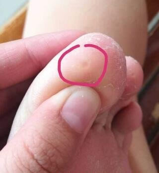 女性hpv症状图片-女性hpv症状图片感染