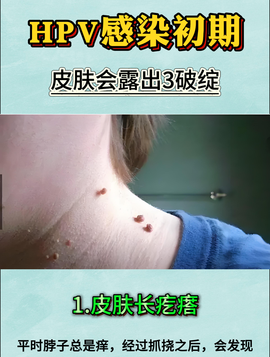 HPV感染(hpv感染用什么药治疗最好)