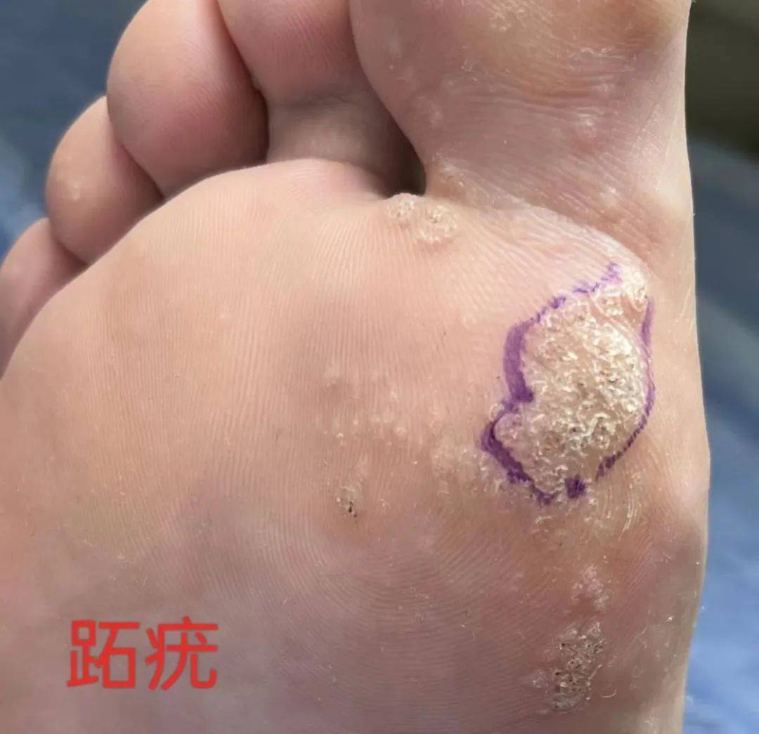 HPV感染(hpv感染用什么药治疗最好)