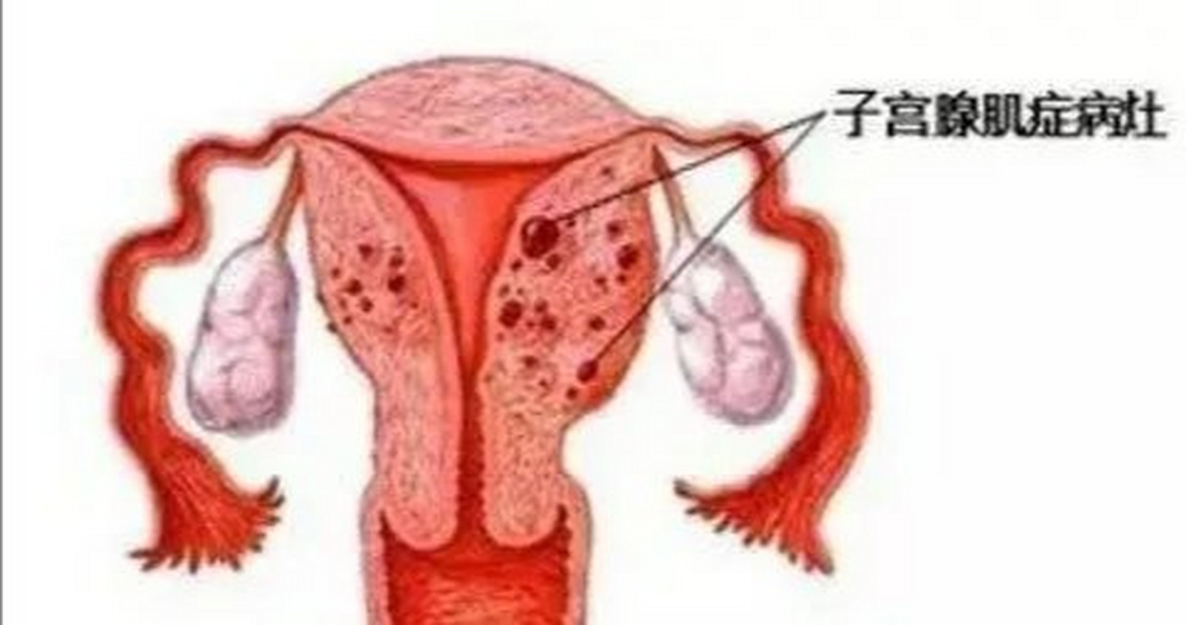 子宫腺肌-子宫腺肌症能治好吗