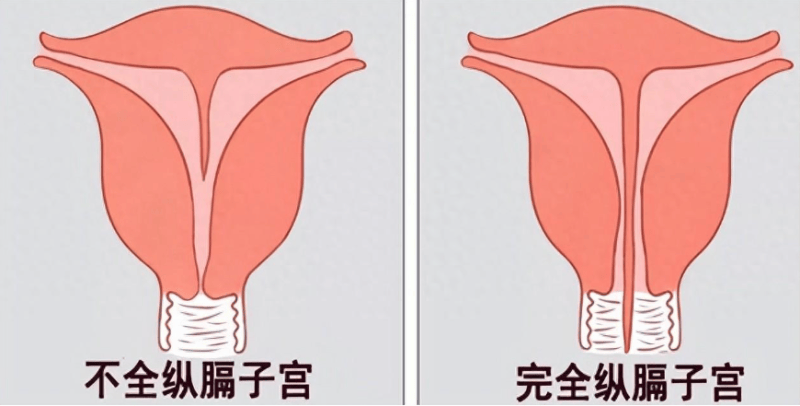 子宫纵隔-(子宫纵隔什么意思)