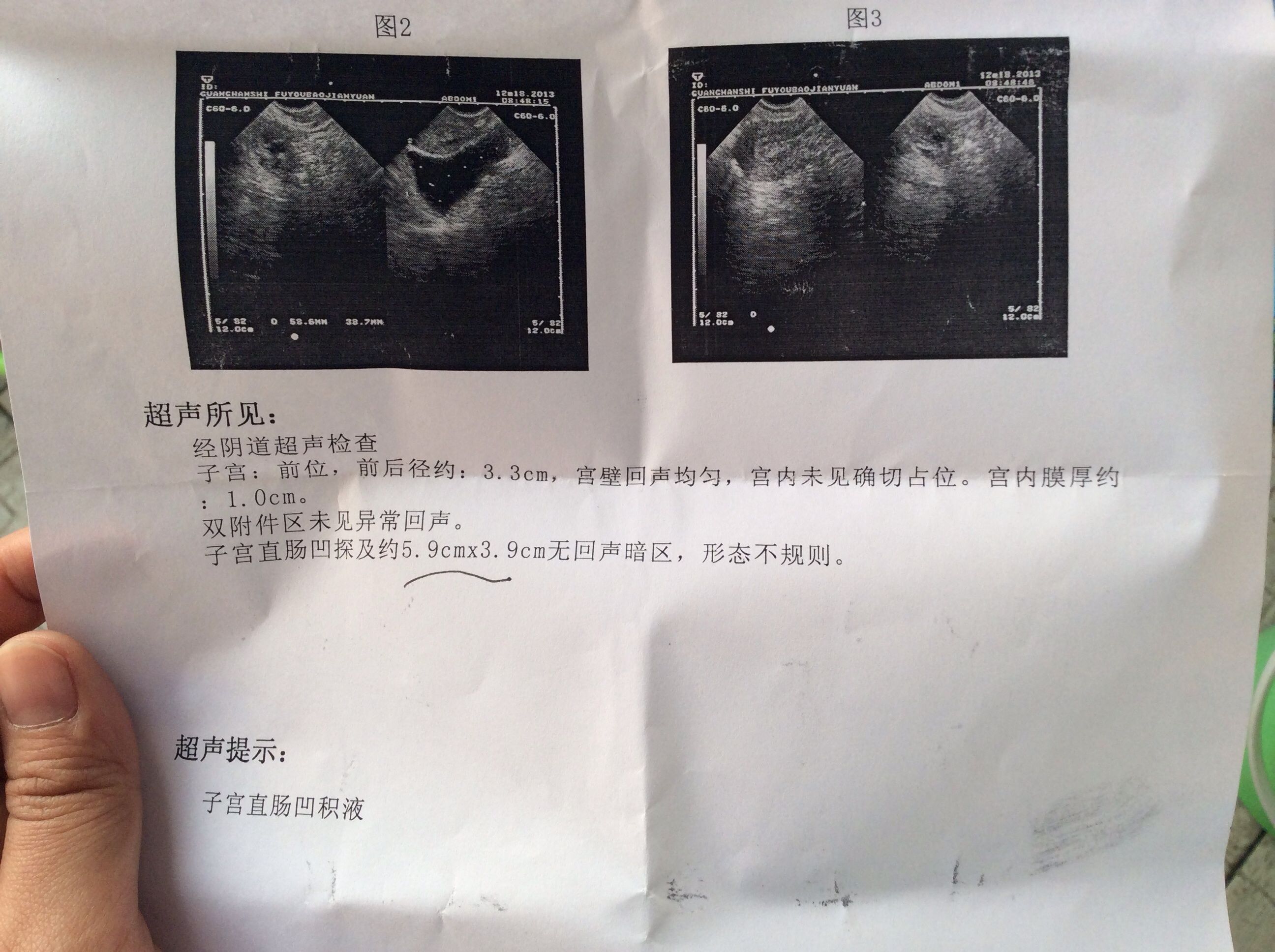 子宫直肠窝积液-子宫直肠窝积液多少mm算正常范围