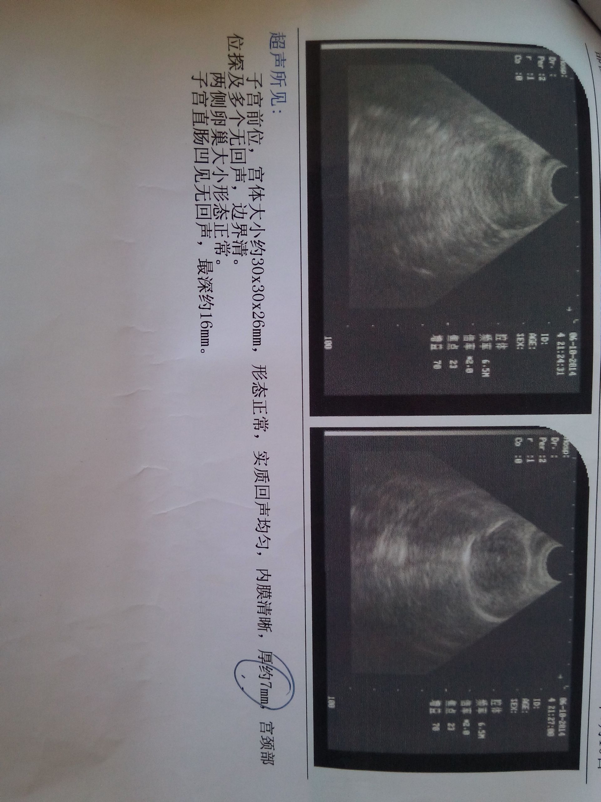 子宫前位是什么意思-子宫前位是什么意思正常吗