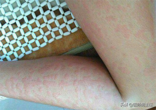艾滋病皮疹-艾滋病皮疹是一个一个还是一片一片