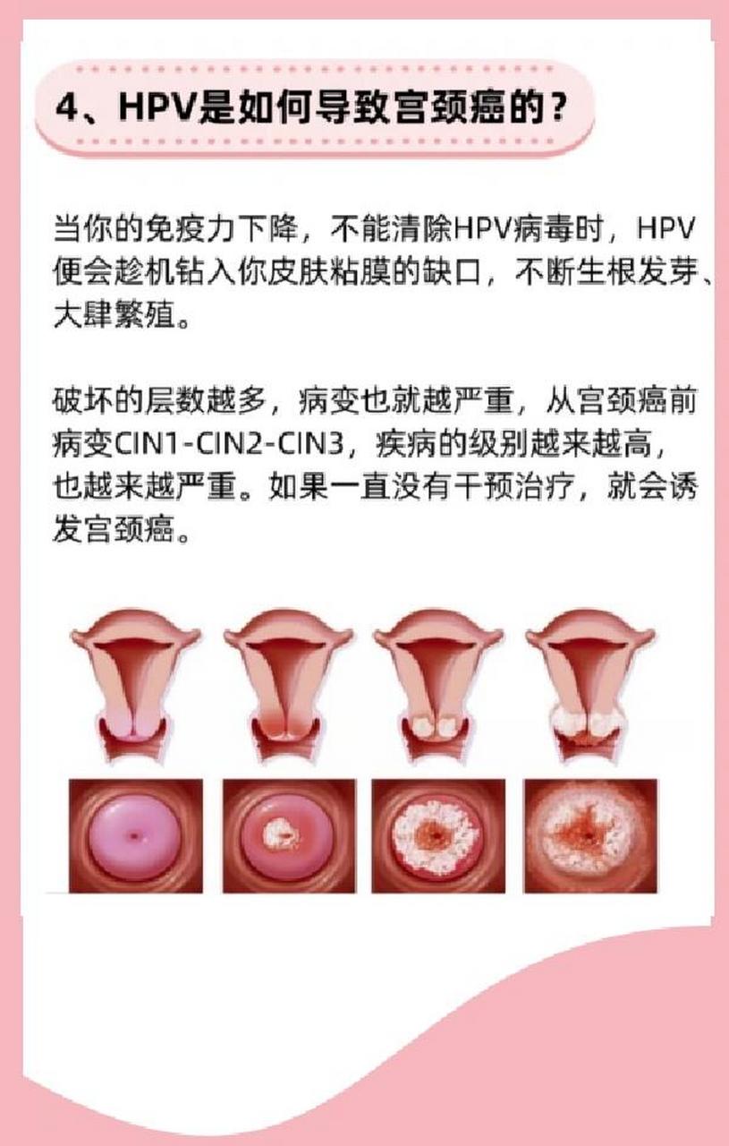 hpv18阳性是什么意思(hpv18阳性是什么意思严重吗会传染给其他人嘛)