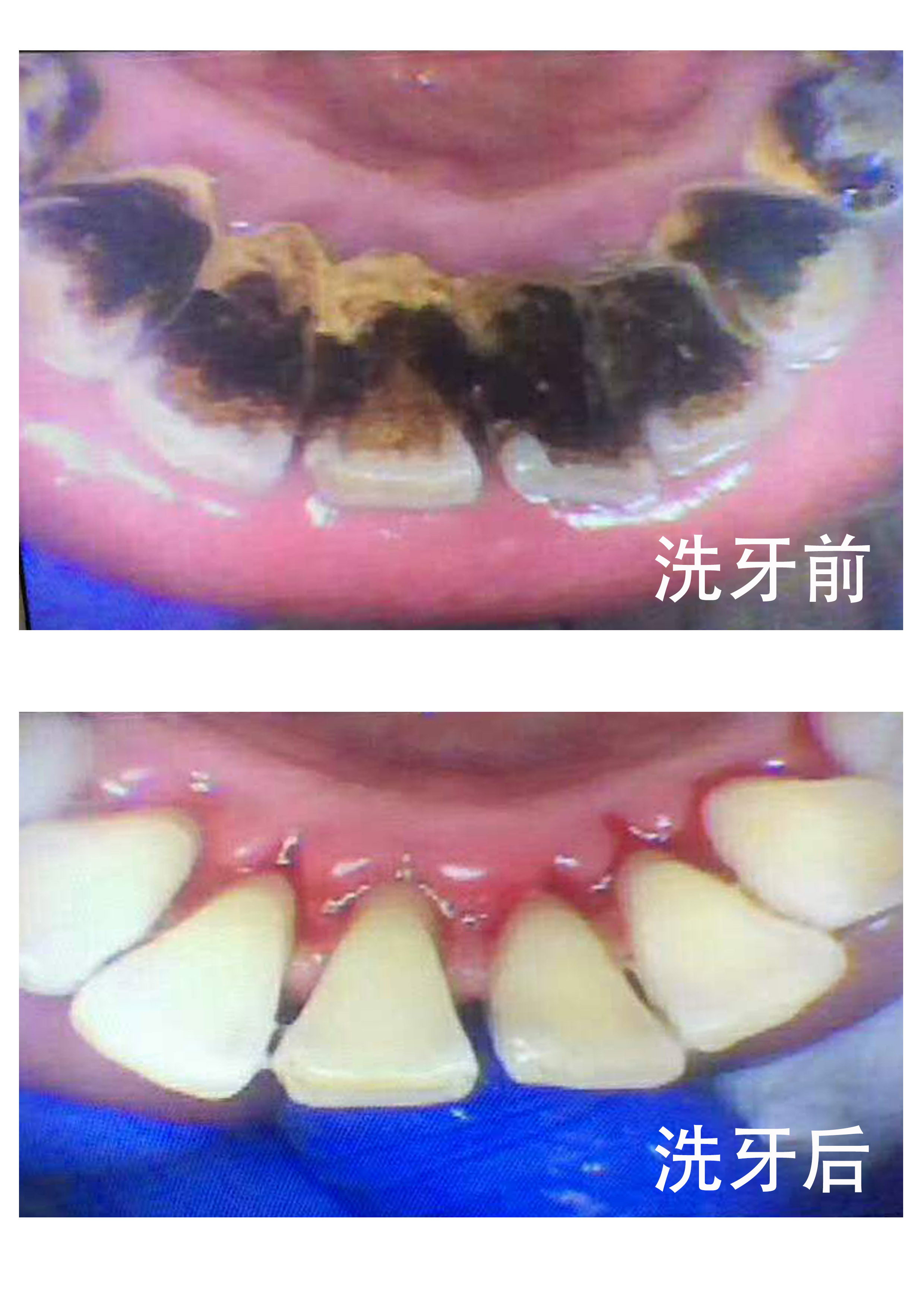 烟渍牙-烟渍牙最怕的三种方法去除