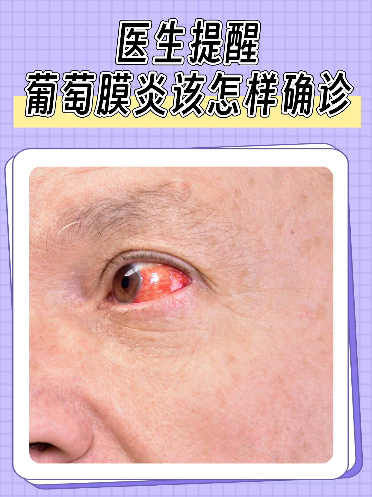 巩膜炎(巩膜炎用什么眼药水)