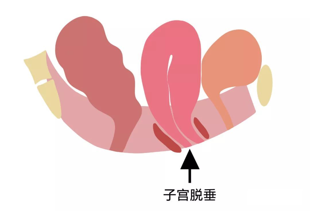 阴道口白色-尿道口流白色分泌物用什么药