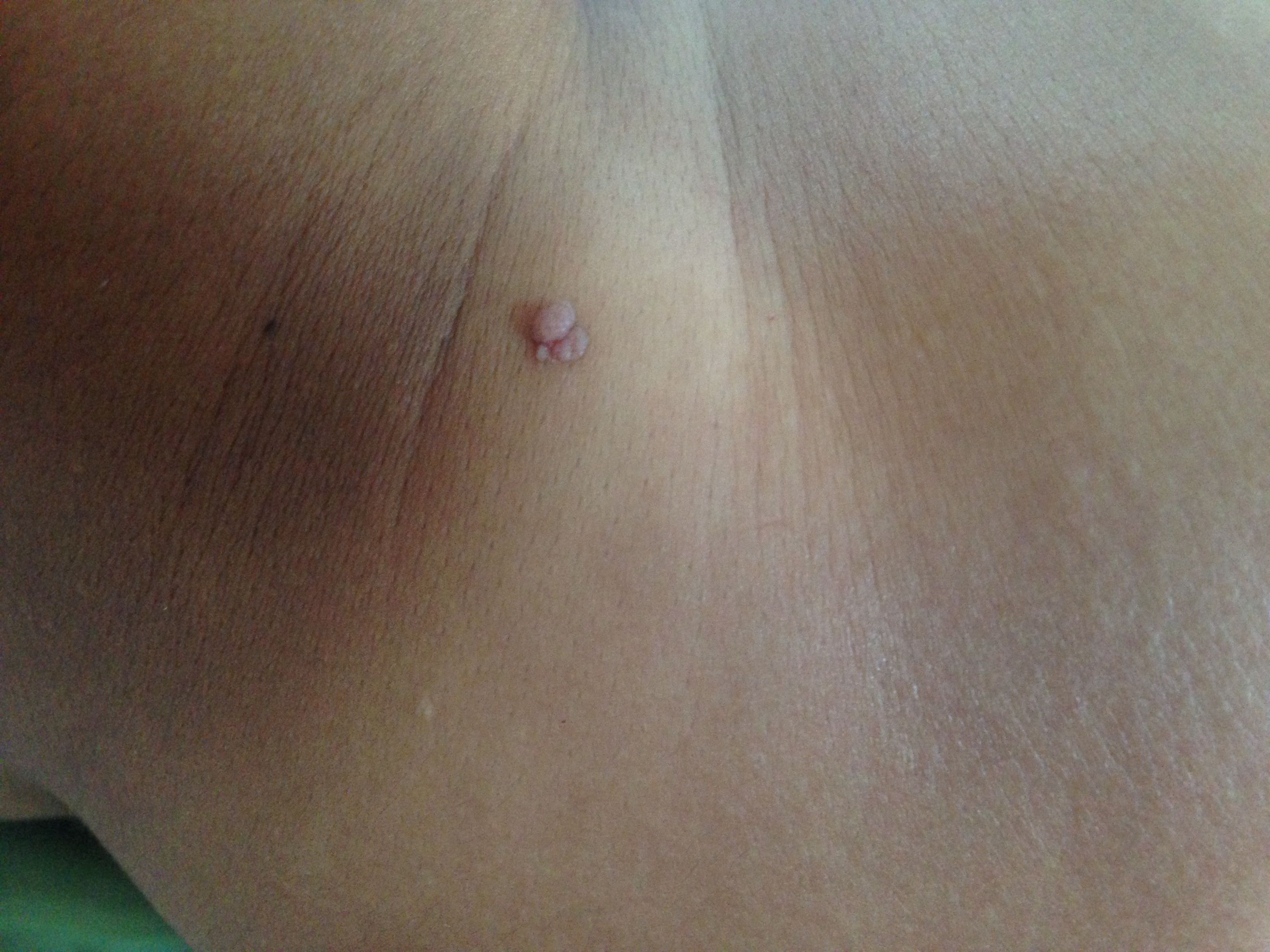 小肉瘤-(小肉瘤图片)