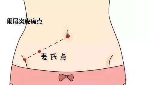麦氏点压痛(麦氏点准确位置图)