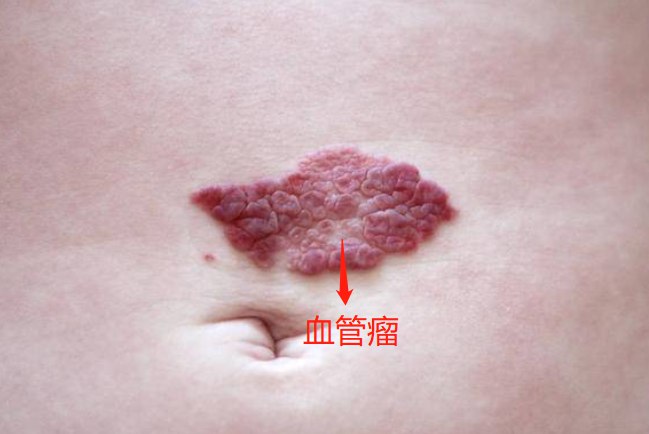 肉芽肿性血管瘤(变应性肉芽肿性血管炎诊断标准)