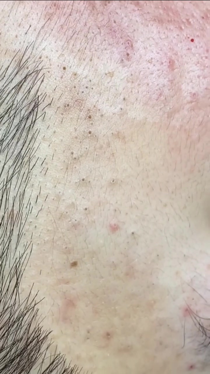 黑头变成痘痘(黑头变成痘痘怎么去除)