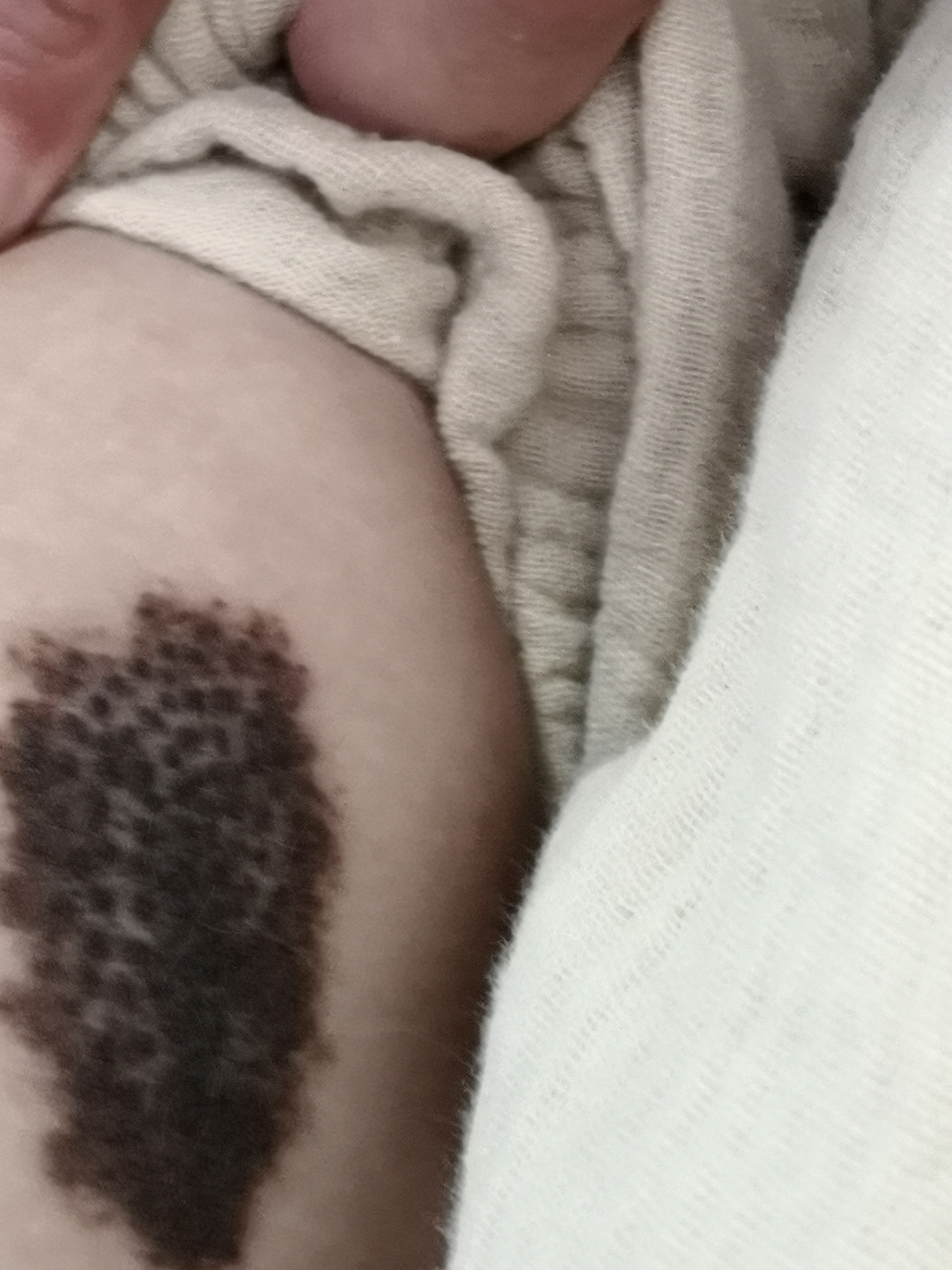 黑毛痣有什么危害-黑毛痣有哪些危害