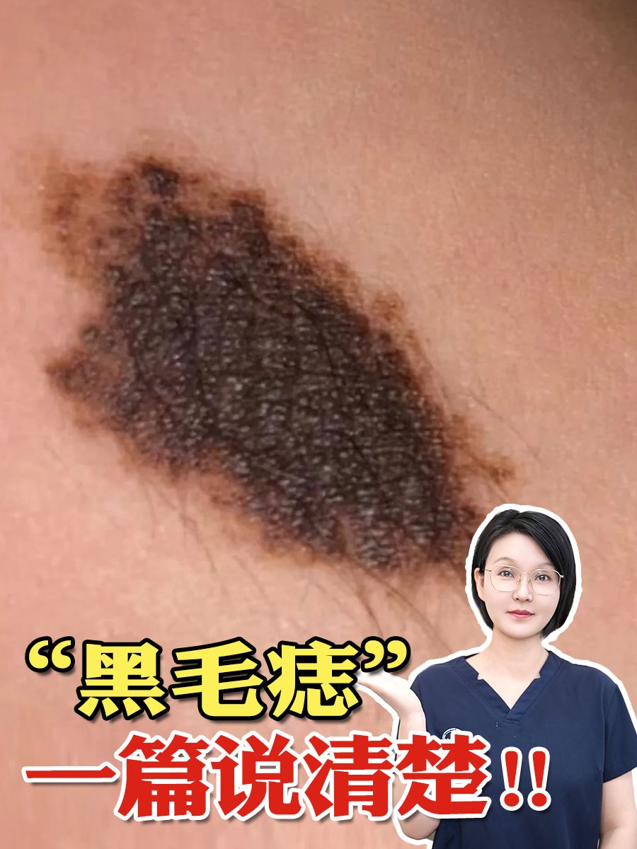黑毛痣有什么危害-黑毛痣有哪些危害