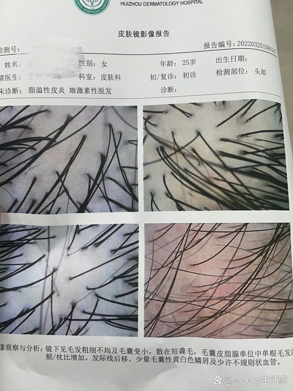 脱发检查哪些项目-(脱发检查哪些项目多少钱)
