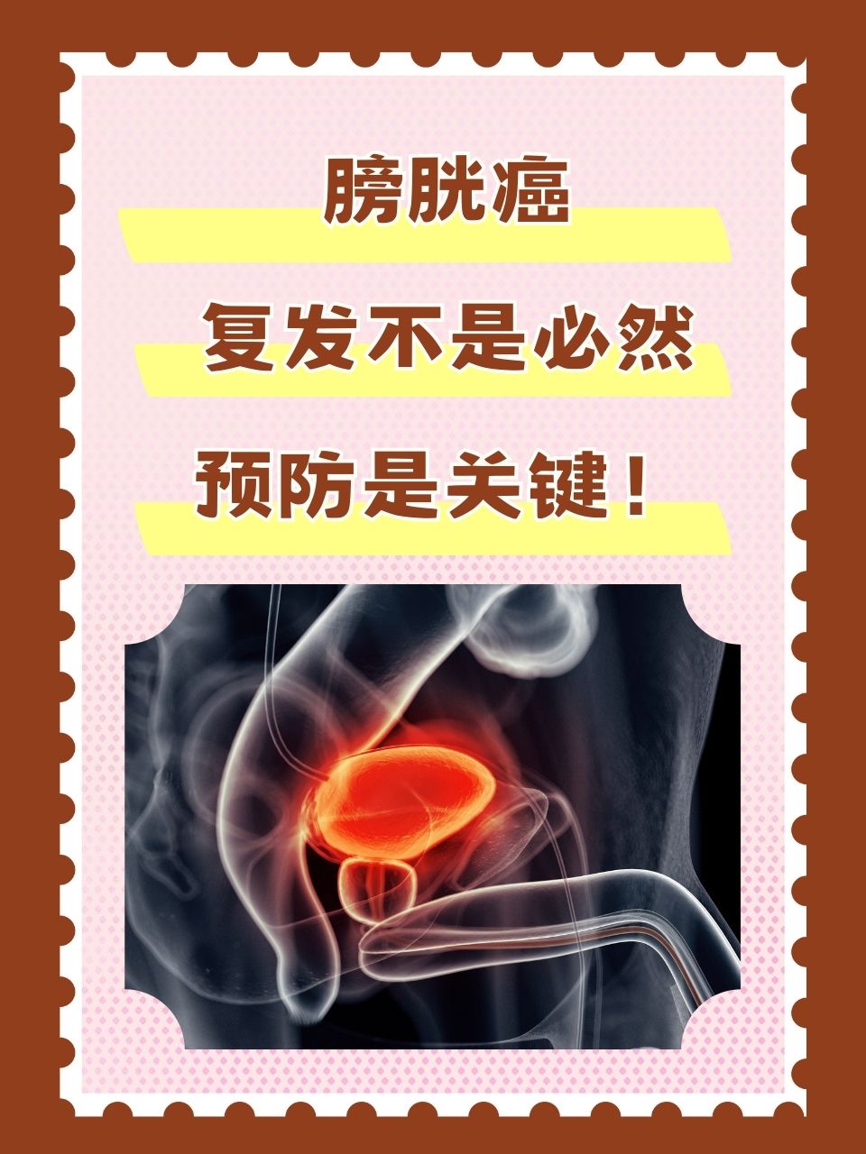 膀胱癌症状(膀胱癌症状的典型表现)