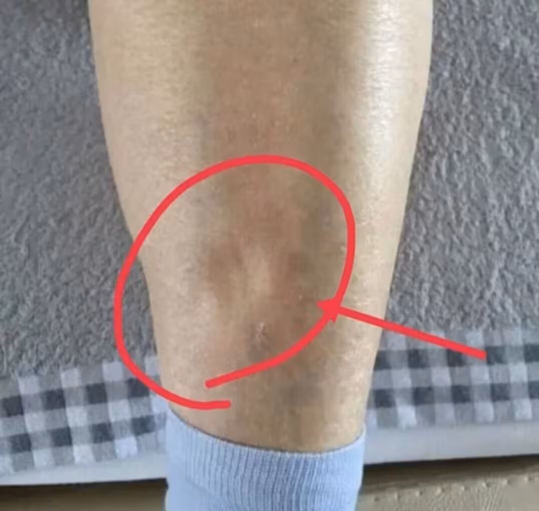 肝腹水是什么症状-肝腹水是什么症状是肝癌晚期么