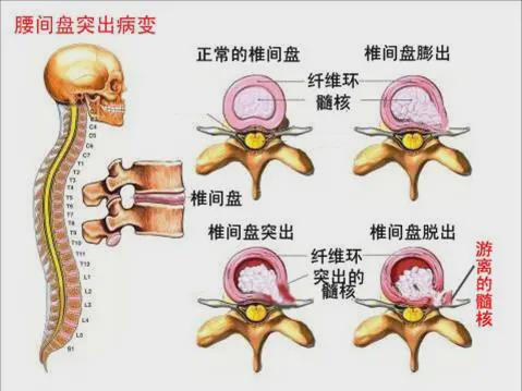 急性腰间盘突出(急性腰间盘突出怎么治疗才能好得快)