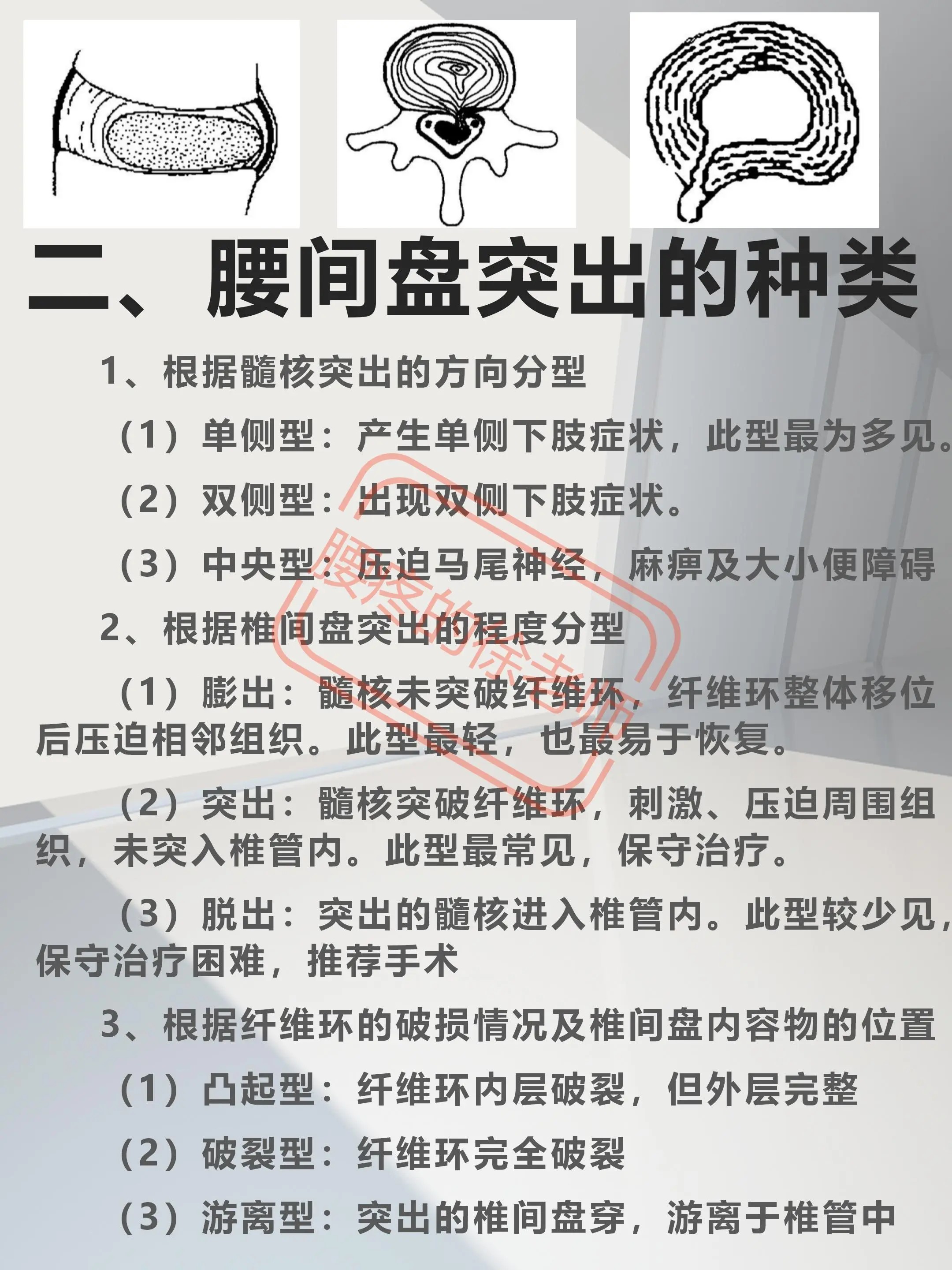 急性腰间盘突出(急性腰间盘突出怎么治疗才能好得快)
