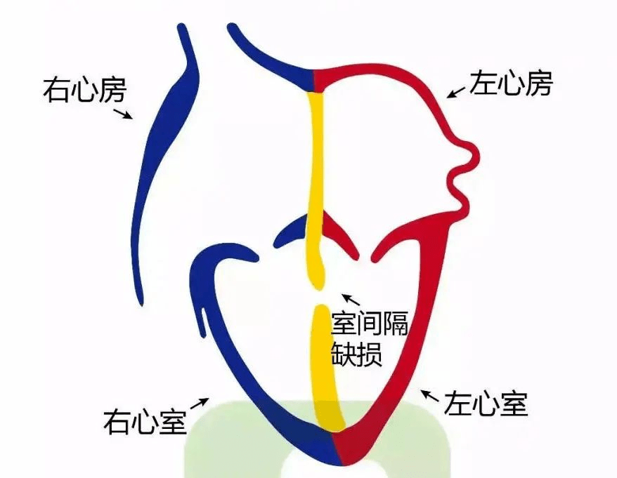 房间隔缺损封堵术-房间隔缺损封堵术是大手术吗