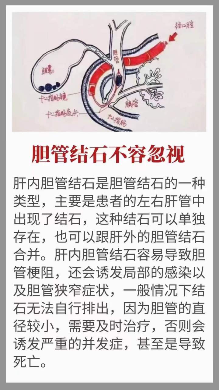 胆管狭窄-(胆管狭窄吃什么药最好)