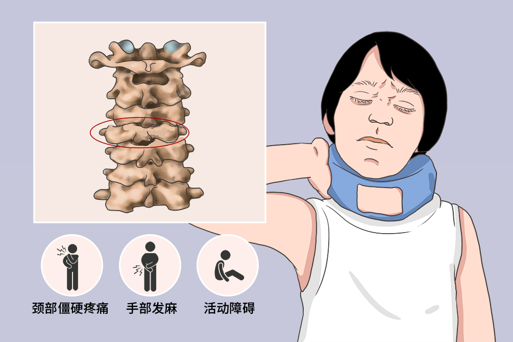 颈椎病遗传吗(颈椎问题会遗传吗)