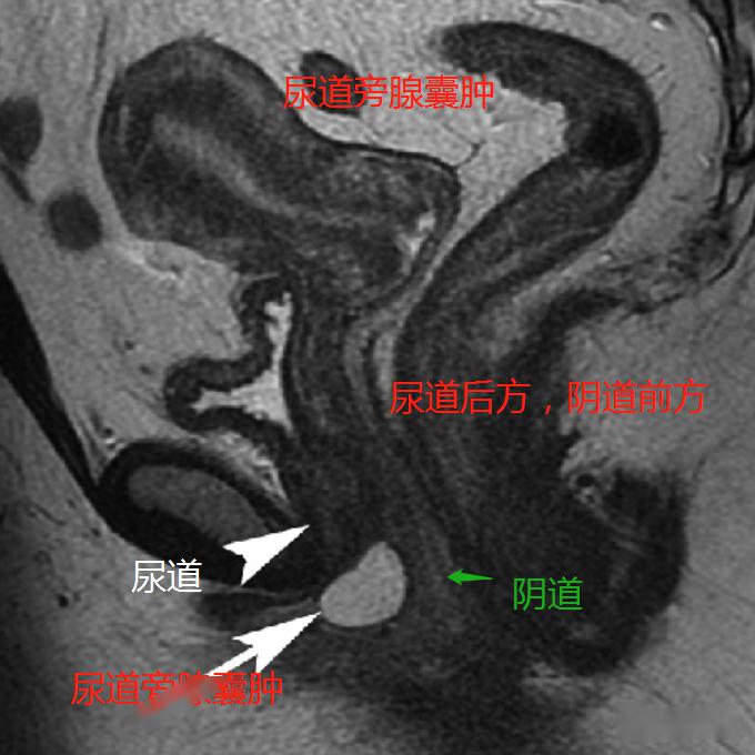 尿道旁腺囊肿-尿道旁腺囊肿手术步骤