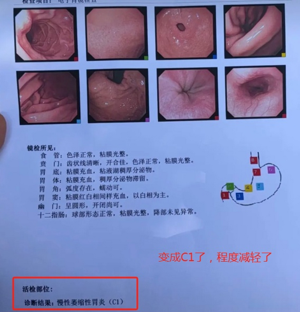 萎缩性胃炎c2-萎缩性胃炎c2什么意思