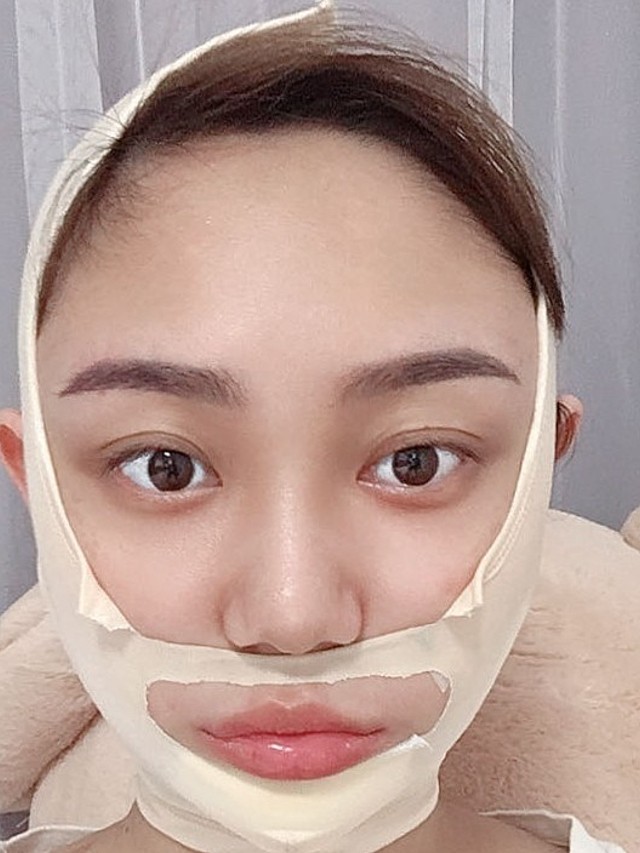 脸部抽脂手术-(脸部抽脂手术后对比图)